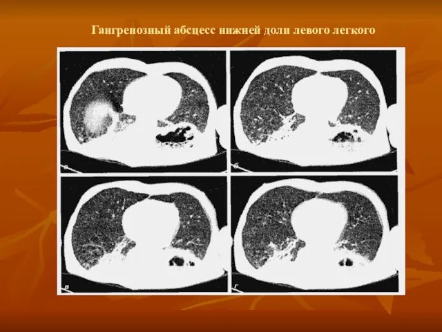 Гангренозный абсцесс нижней доли левого легкого