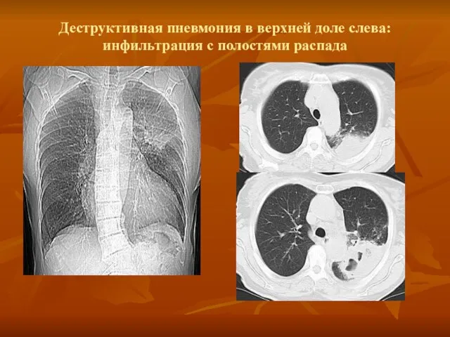 Деструктивная пневмония в верхней доле слева: инфильтрация с полостями распада
