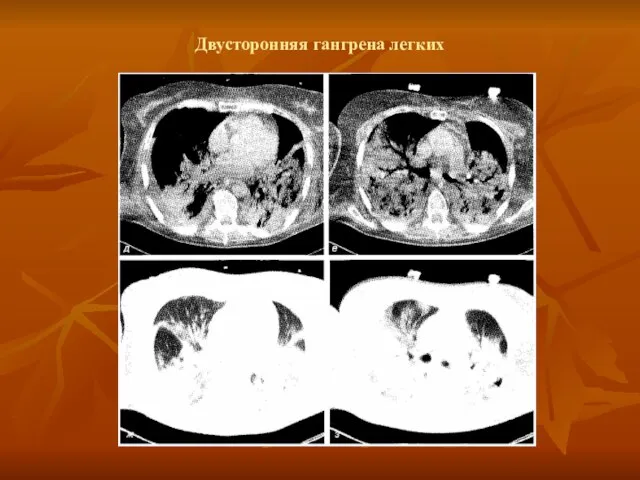 Двусторонняя гангрена легких