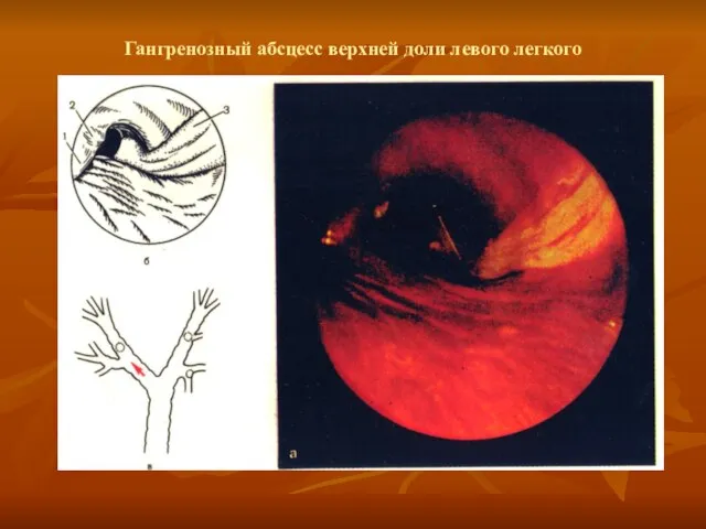 Гангренозный абсцесс верхней доли левого легкого