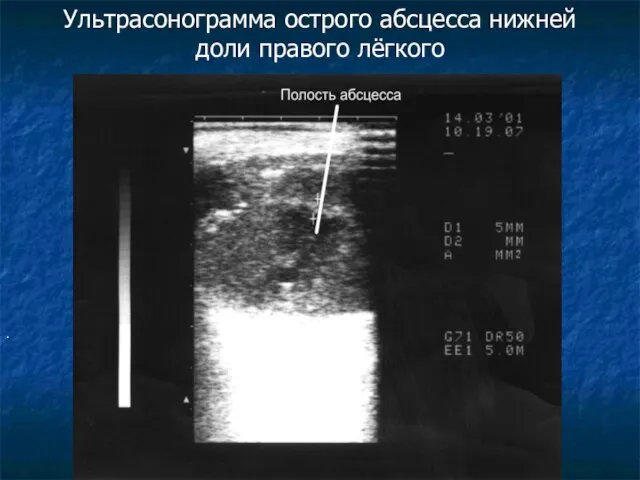 Ультрасонограмма острого абсцесса нижней доли правого лёгкого .