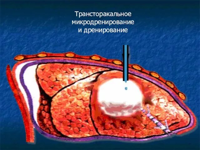 Трансторакальное микродренирование и дренирование