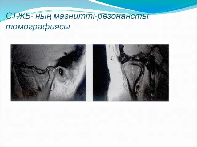 СТЖБ- ның магнитті-резонансты томографиясы