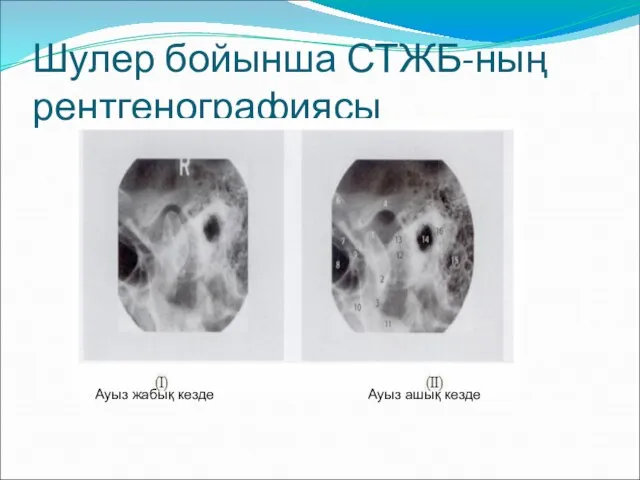 Шулер бойынша СТЖБ-ның рентгенографиясы Ауыз жабық кезде Ауыз ашық кезде