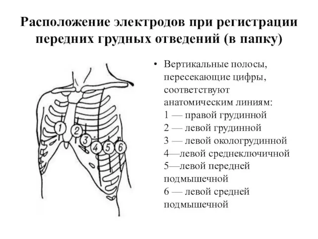 Расположение электродов при регистрации передних грудных отведений (в папку) Вертикальные полосы, пересекающие