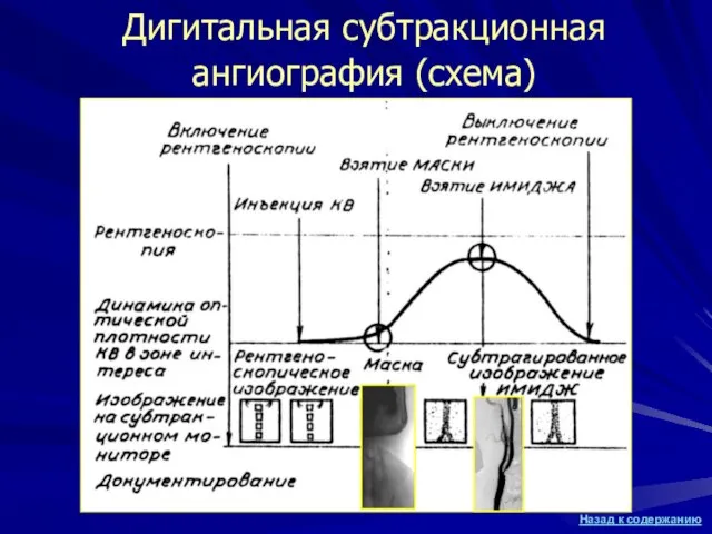 Дигитальная субтракционная ангиография (схема)