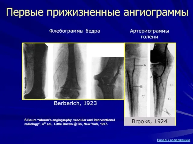 Первые прижизненные ангиограммы Berberich, 1923 S.Baum “Abram’s angiography, vascular and interventional radiology”,