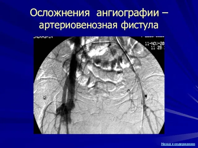 Осложнения ангиографии – артериовенозная фистула