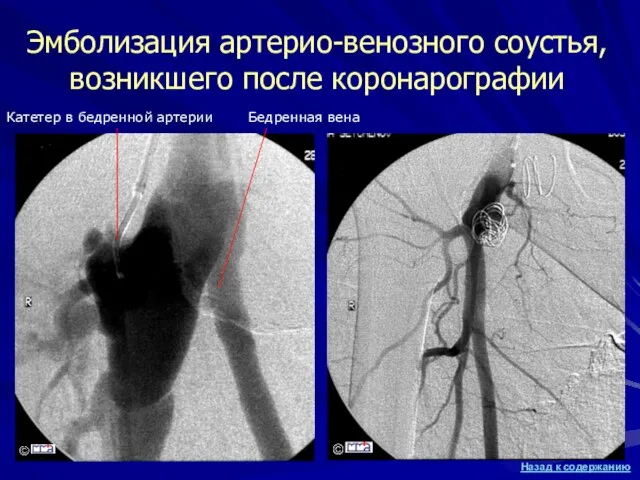 Эмболизация артерио-венозного соустья, возникшего после коронарографии Катетер в бедренной артерии Бедренная вена