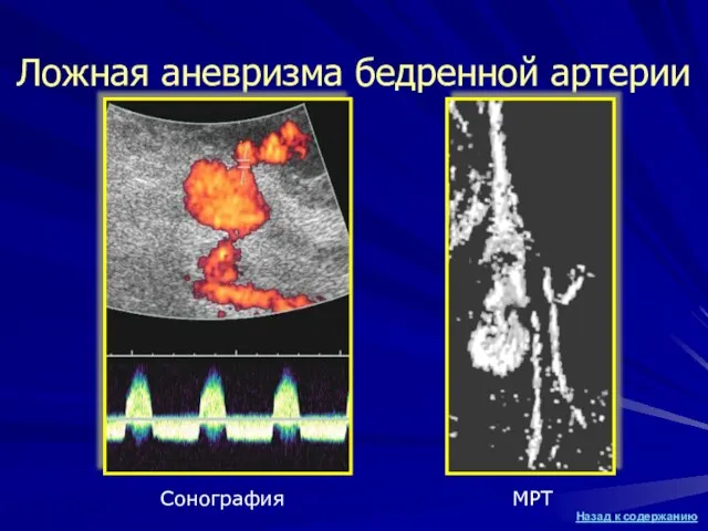 Ложная аневризма бедренной артерии Сонография МРТ