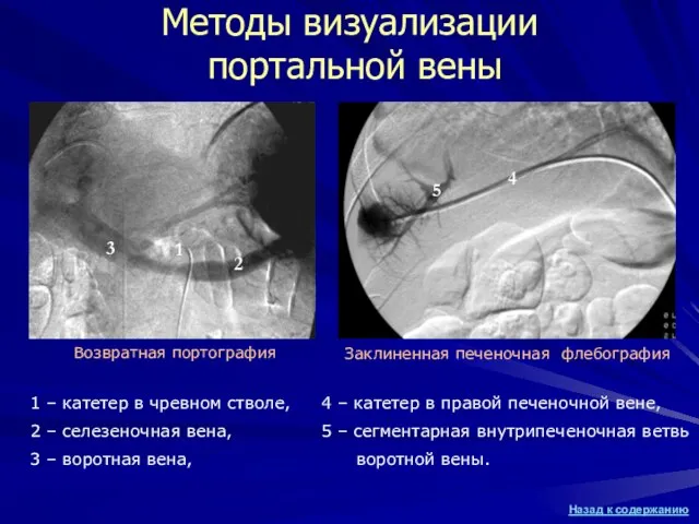 Методы визуализации портальной вены Возвратная портография Заклиненная печеночная флебография 3 1 2