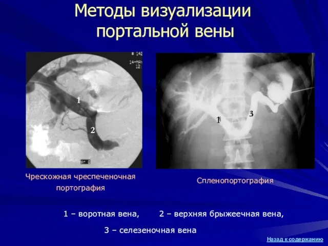 Методы визуализации портальной вены Спленопортография 2 1 3 1 1 – воротная