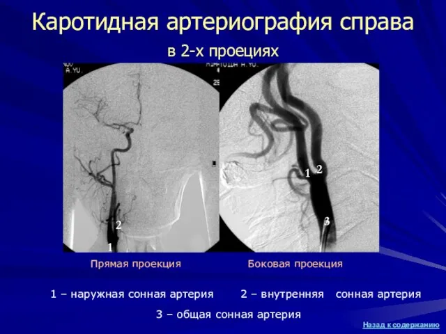 Каротидная артериография справа в 2-х проециях 1 – наружная сонная артерия 1