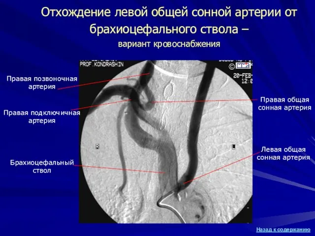 Отхождение левой общей сонной артерии от брахиоцефального ствола – вариант кровоснабжения Правая