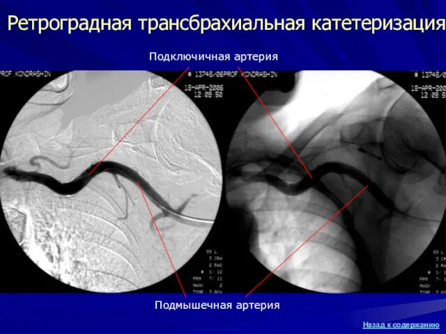 Ретроградная трансбрахиальная катетеризация Подмышечная артерия Подключичная артерия