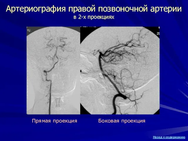 Артериография правой позвоночной артерии в 2-х проекциях Прямая проекция Боковая проекция