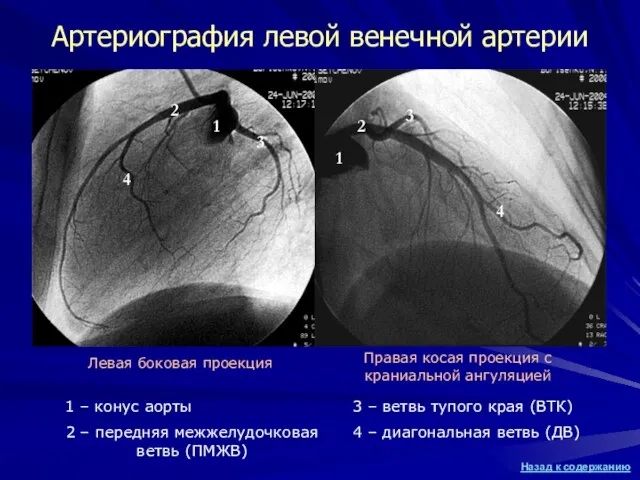 Артериография левой венечной артерии 1 – конус аорты 2 – передняя межжелудочковая