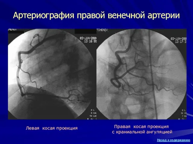 Артериография правой венечной артерии