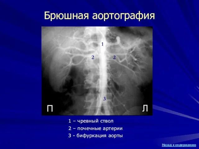 Брюшная аортография 1 2 2 3 1 – чревный ствол 2 –