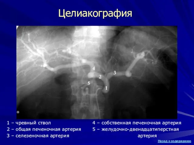 Целиакография 1 – чревный ствол 2 – общая печеночная артерия 3 –