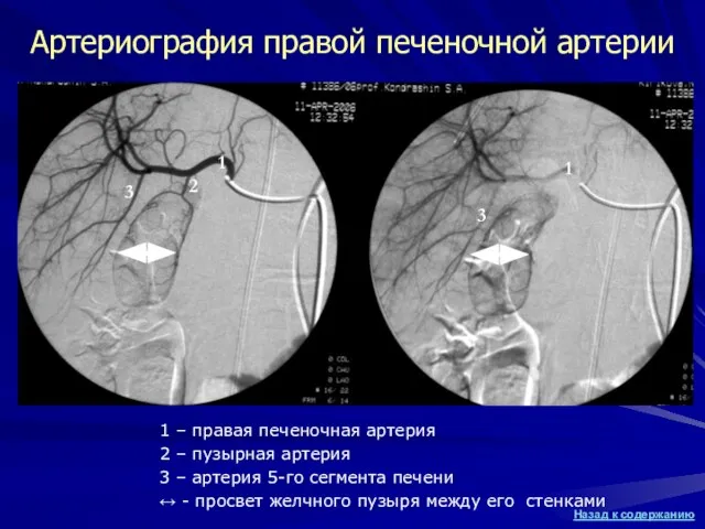 1 – правая печеночная артерия 2 – пузырная артерия 3 – артерия