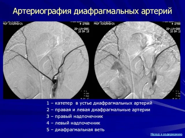 1 – катетер в устье диафрагмальных артерий 2 – правая и левая