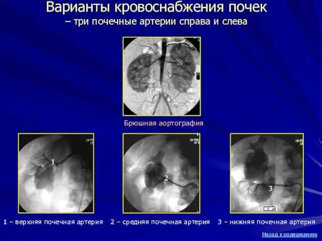 Варианты кровоснабжения почек – три почечные артерии справа и слева Брюшная аортография