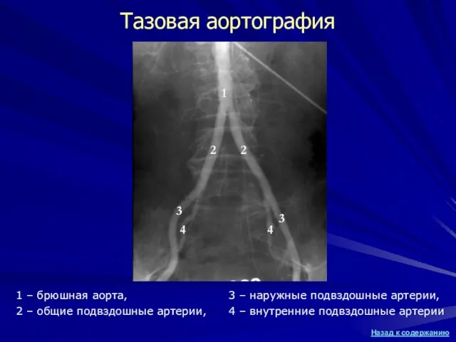 Тазовая аортография 3 – наружные подвздошные артерии, 4 – внутренние подвздошные артерии