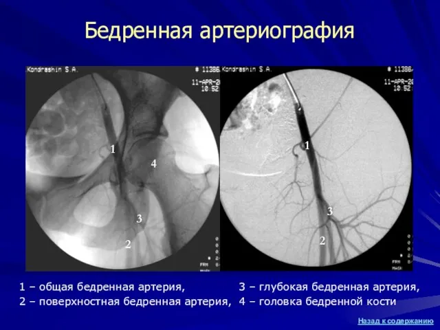 Бедренная артериография 1 – общая бедренная артерия, 2 – поверхностная бедренная артерия,