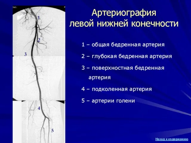 1 – общая бедренная артерия 2 – глубокая бедренная артерия 3 –