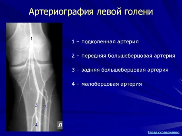 Артериография левой голени 1 – подколенная артерия 2 – передняя большеберцовая артерия