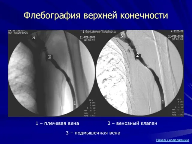 Флебография верхней конечности 1 – плечевая вена 2 – венозный клапан 3 – подмышечная вена