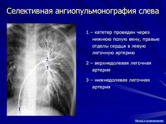 Селективная ангиопульмонография слева 1 – катетер проведен через нижнюю полую вену, правые