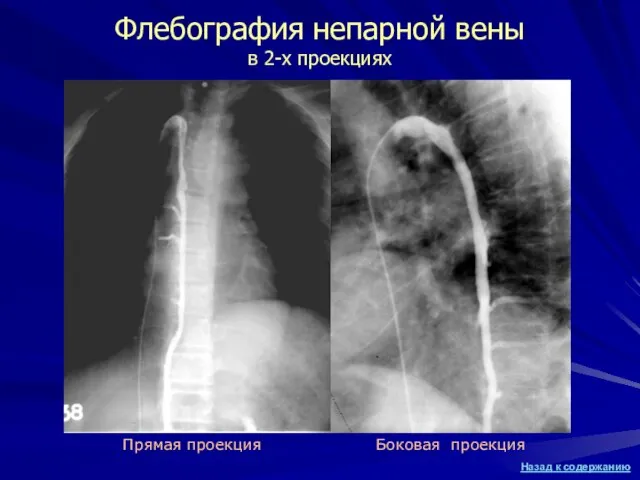 Флебография непарной вены в 2-х проекциях