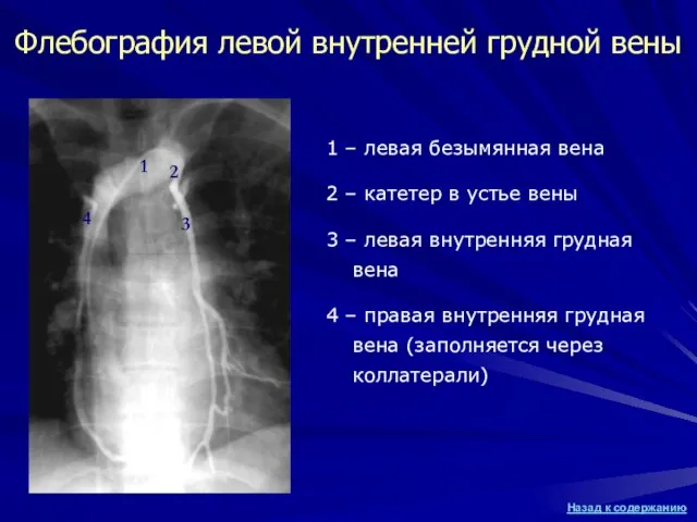 Флебография левой внутренней грудной вены 1 – левая безымянная вена 2 –