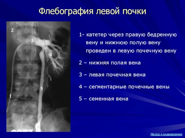 Флебография левой почки 1- катетер через правую бедренную вену и нижнюю полую