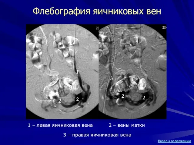 Флебография яичниковых вен 1 – левая яичниковая вена 1 3 – правая