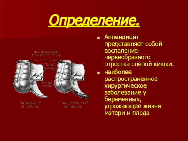 Определение. Аппендицит представляет собой воспаление червеобразного отростка слепой кишки. наиболее распространенное хирургическое