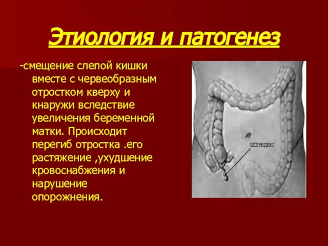 Этиология и патогенез -смещение слепой кишки вместе с червеобразным отростком кверху и