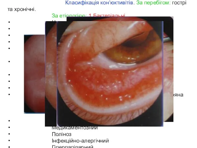 Класифікація кон’юктивітів. За перебігом: гострі та хронічні. За етіологією: 1.Бактеріальні Неспецифічний катаральний