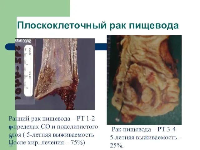 Плоскоклеточный рак пищевода Ранний Ранний рак пищевода – PT 1-2 в пределах