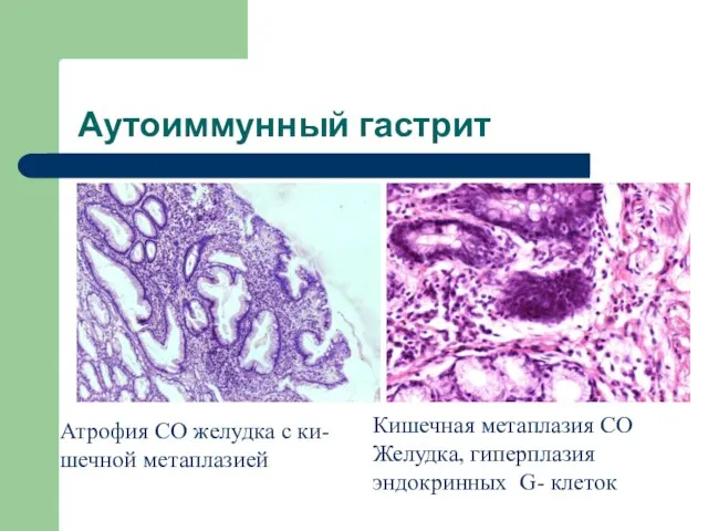 Аутоиммунный гастрит Атрофия СО желудка с ки- шечной метаплазией Кишечная метаплазия СО