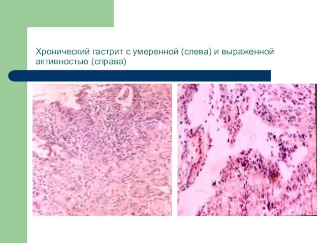 Хронический гастрит с умеренной (слева) и выраженной активностью (справа)