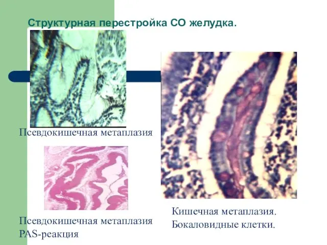 Структурная перестройка СО желудка. Псевдокишечная метаплазия Псевдокишечная метаплазия PAS-реакция Кишечная метаплазия. Бокаловидные клетки.