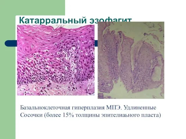 Катарральный эзофагит Базальноклеточная гиперплазия МПЭ. Удлиненные Сосочки (более 15% толщины эпителиаьного пласта)