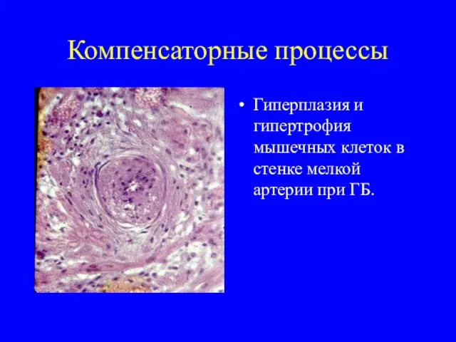 Компенсаторные процессы Гиперплазия и гипертрофия мышечных клеток в стенке мелкой артерии при ГБ.