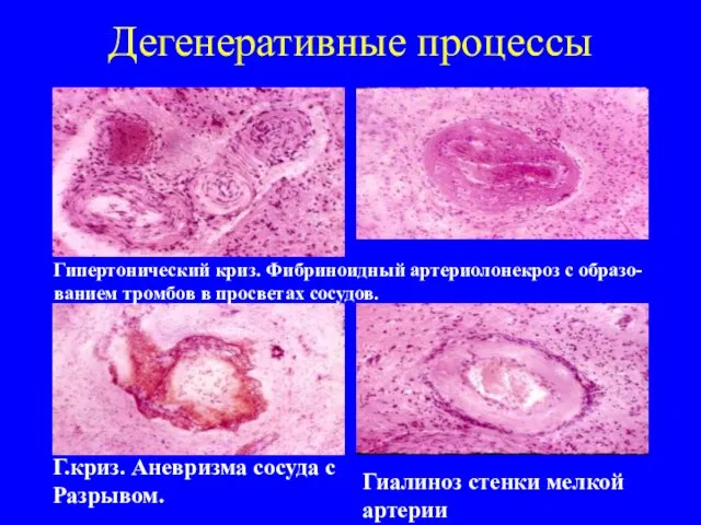 Дегенеративные процессы Гипертонический криз. Фибриноидный артериолонекроз с образо-ванием тромбов в просветах сосудов.
