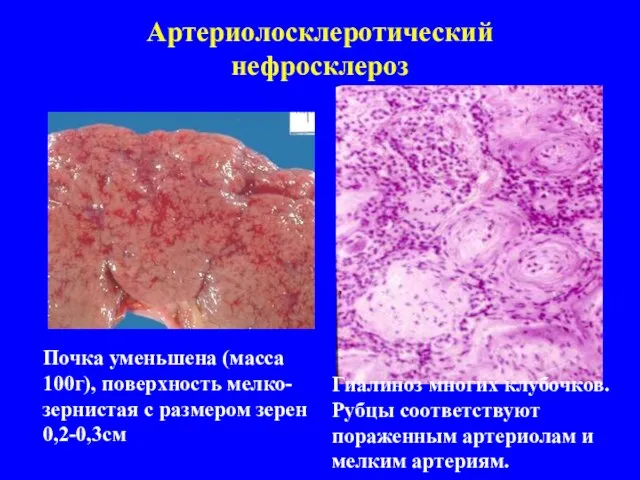 Артериолосклеротический нефросклероз Почка уменьшена (масса 100г), поверхность мелко- зернистая с размером зерен