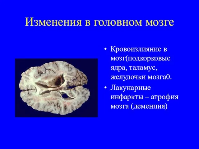 Изменения в головном мозге Кровоизлияние в мозг(подкорковые ядра, таламус, желудочки мозга0. Лакунарные