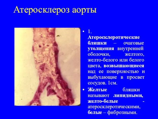 Атеросклероз аорты 1. Атеросклеротические бляшки – очаговые утолщения внутренней оболочки, желтого, желто-белого
